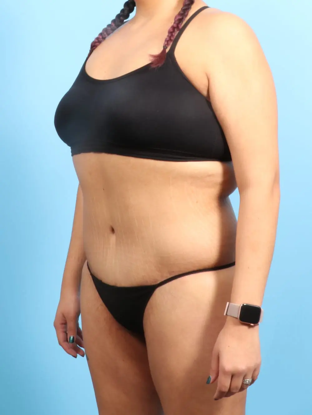 After Weight Loss Patient Photo - Case 20638 - after view-1