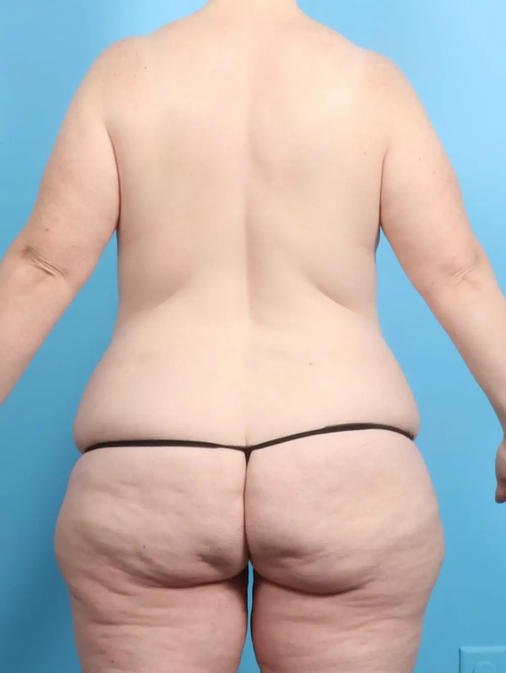 After Weight Loss Patient Photo - Case 20648 - before view-3