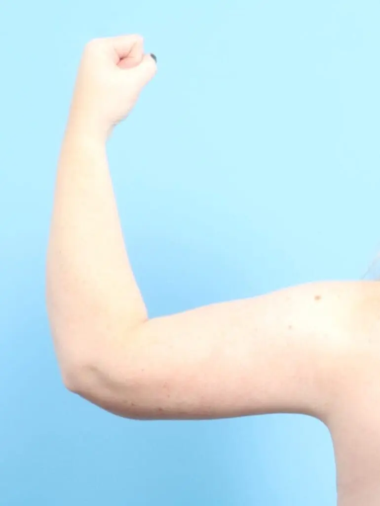 After Weight Loss - Case 20668 - After