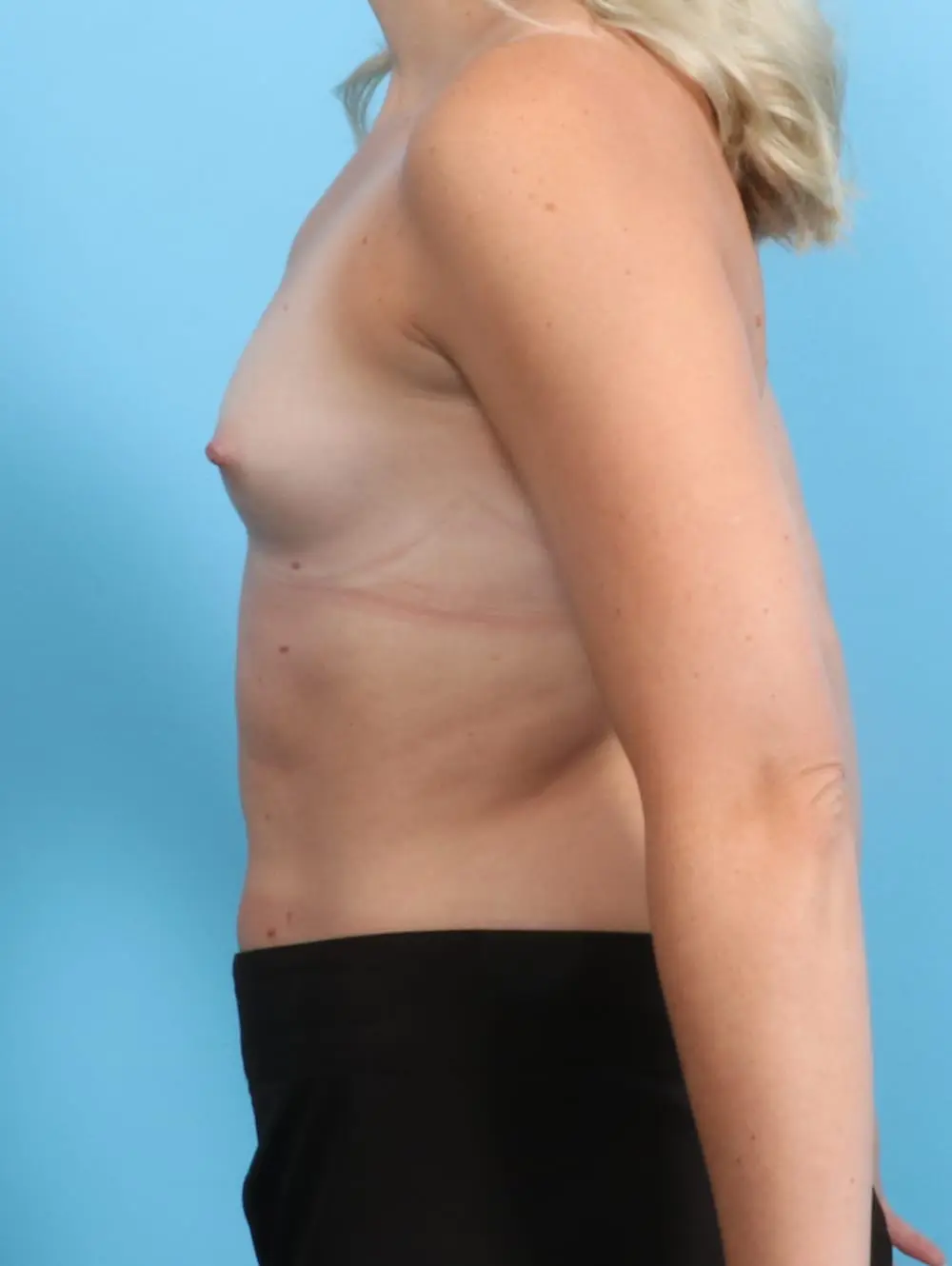 Breast Augmentation Patient Photo - Case 20680 - before view-2