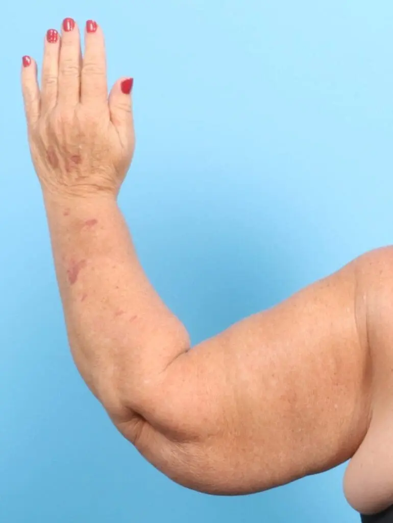 Arm Lift - Case 20747 - After