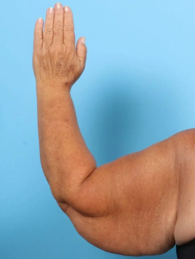 Arm Lift - Case 20747 - Before