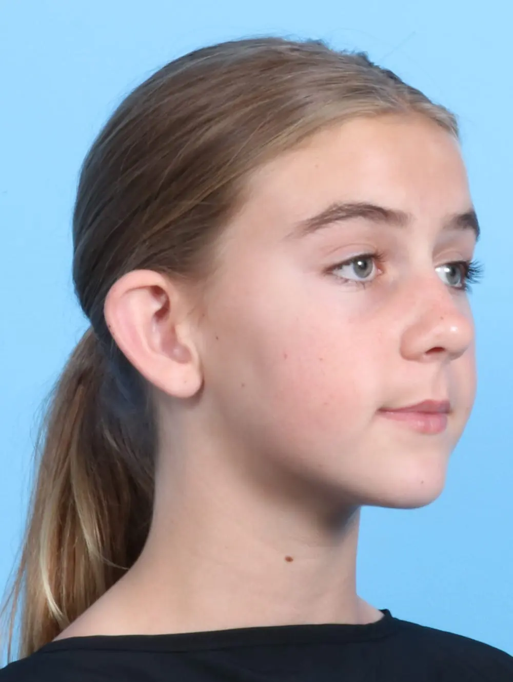 Otoplasty Patient Photo - Case 20933 - before view-1