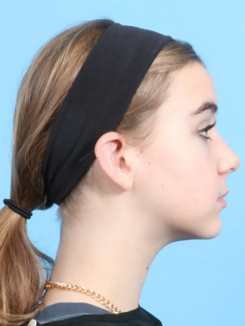 Otoplasty Patient Photo - Case 20933 - after view-2
