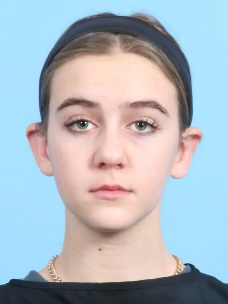 Otoplasty - Case 20933 - After