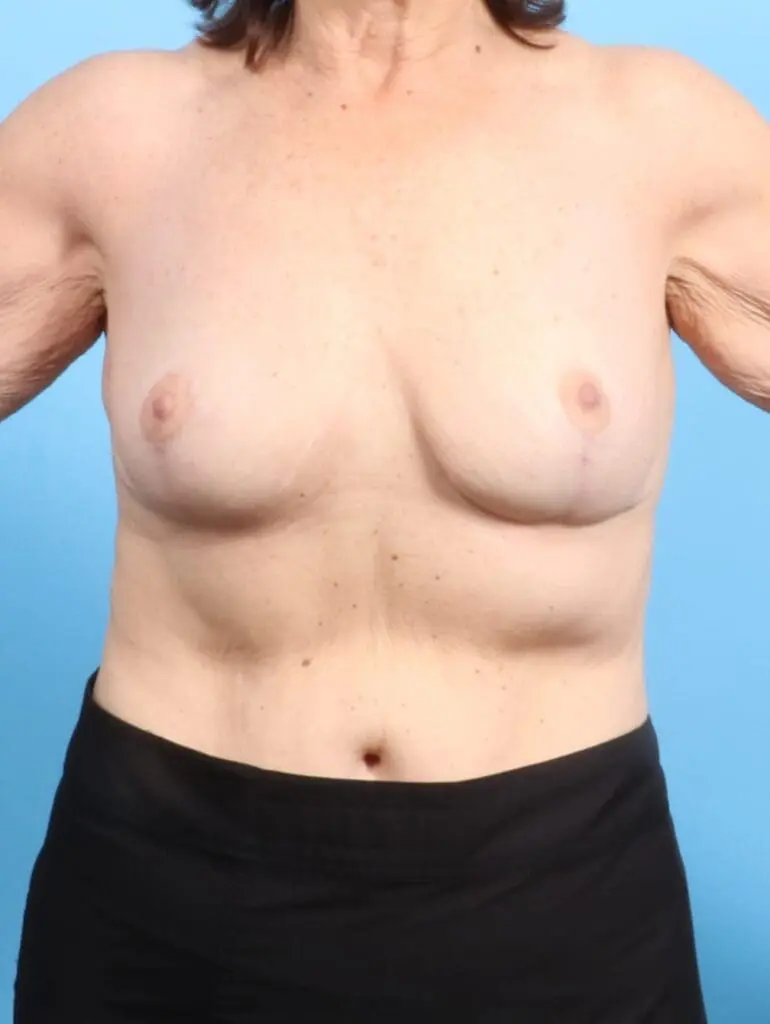 Breast Implant Removal - Case 20952 - After