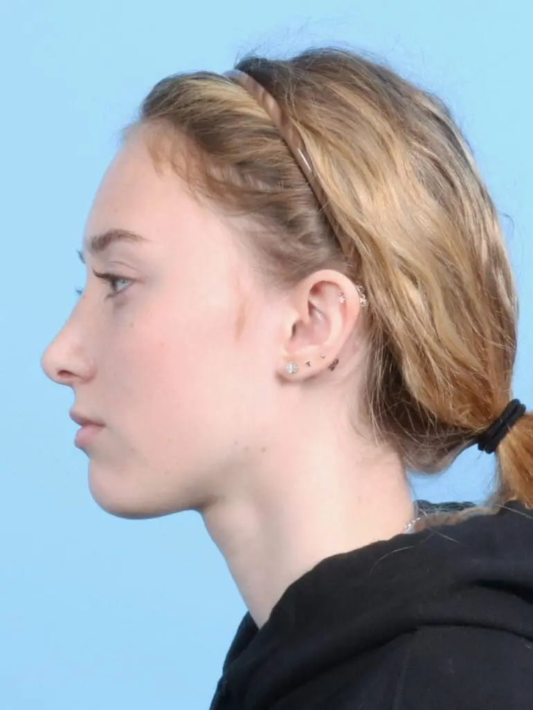 Rhinoplasty - Case 20974 - After