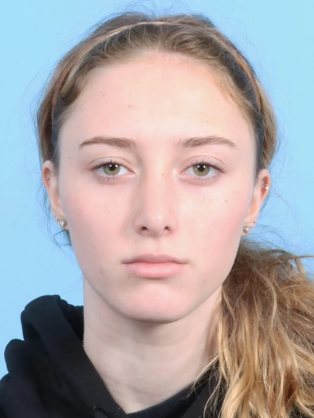 Rhinoplasty Patient Photo - Case 20974 - after view-1