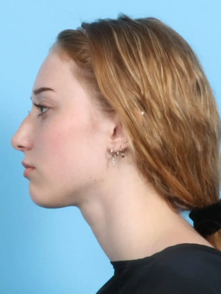 Rhinoplasty - Case 20974 - Before
