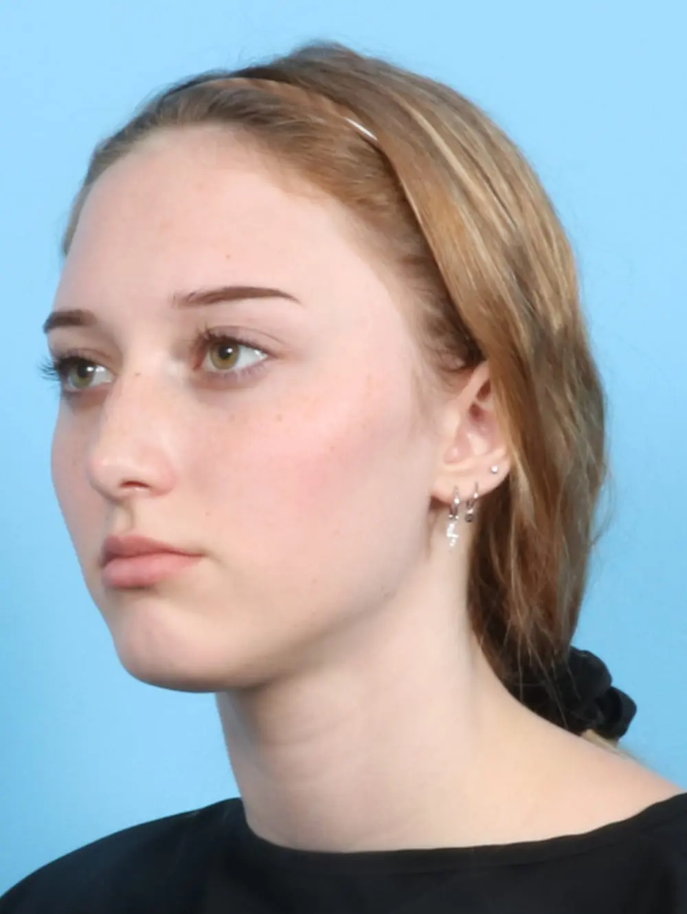 Rhinoplasty Patient Photo - Case 20974 - before view-2