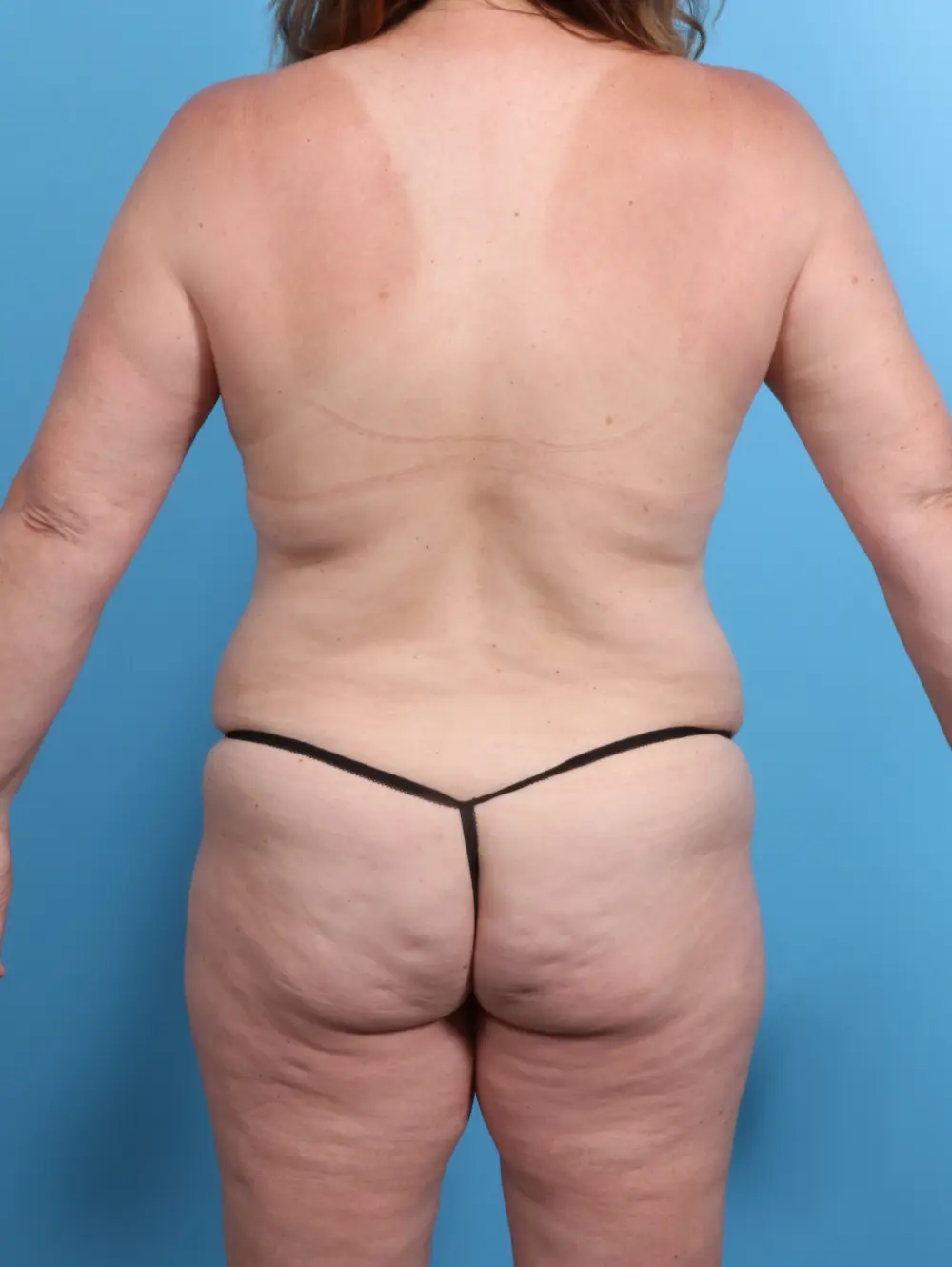 Body Lift Patient Photo - Case 20982 - before view-3