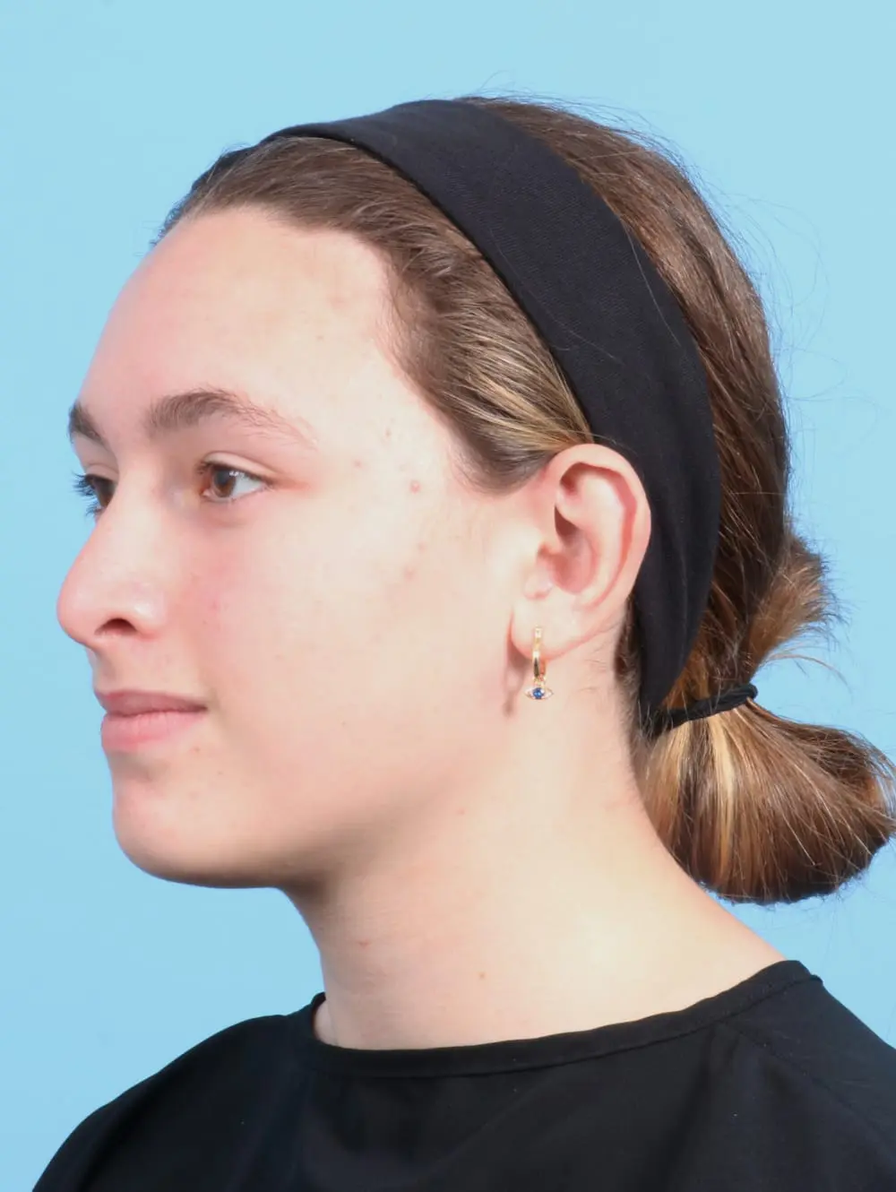 Otoplasty Patient Photo - Case 21016 - after view-1