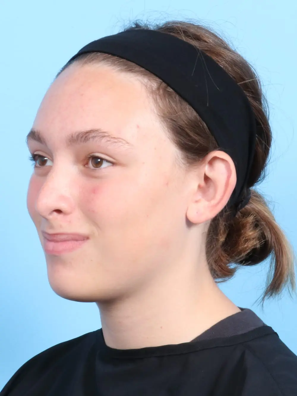 Otoplasty Patient Photo - Case 21016 - before view-1