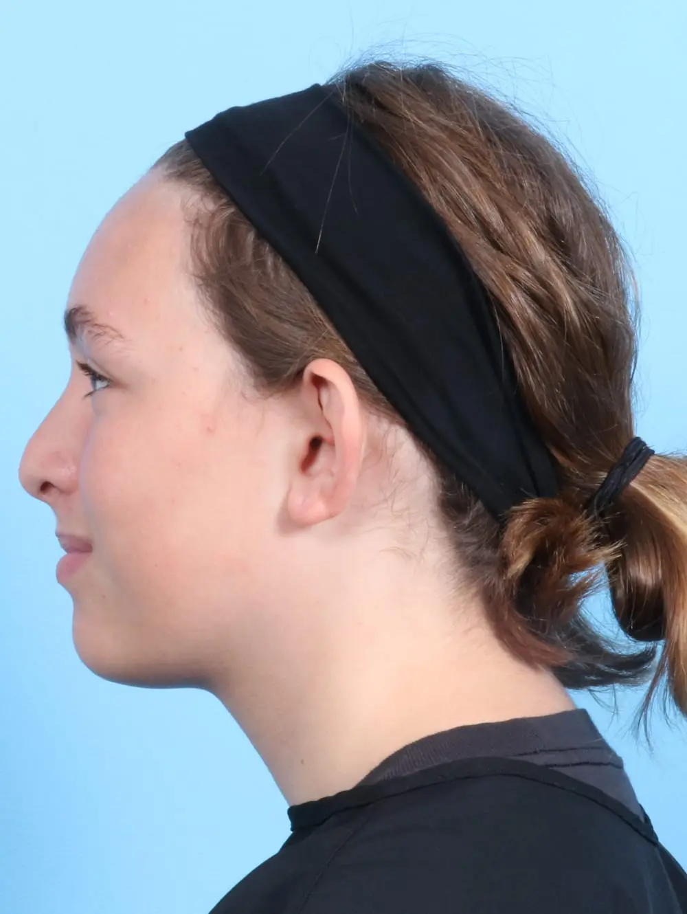 Otoplasty Patient Photo - Case 21016 - before view-2