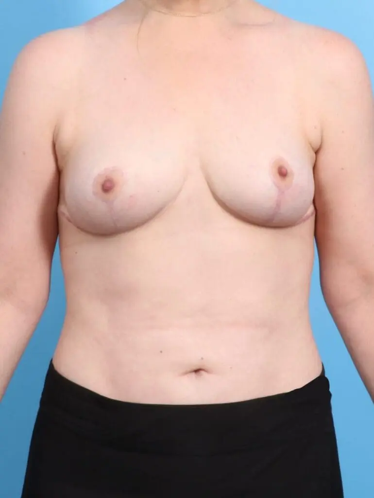 Breast Implant Removal - Case 21069 - After