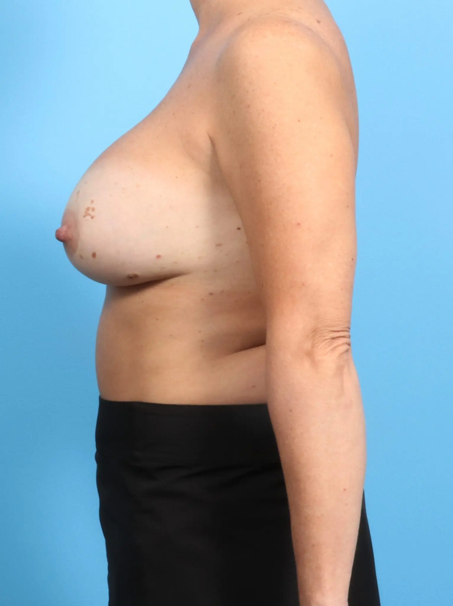Breast Implant Removal Patient Photo - Case 21077 - before view-2