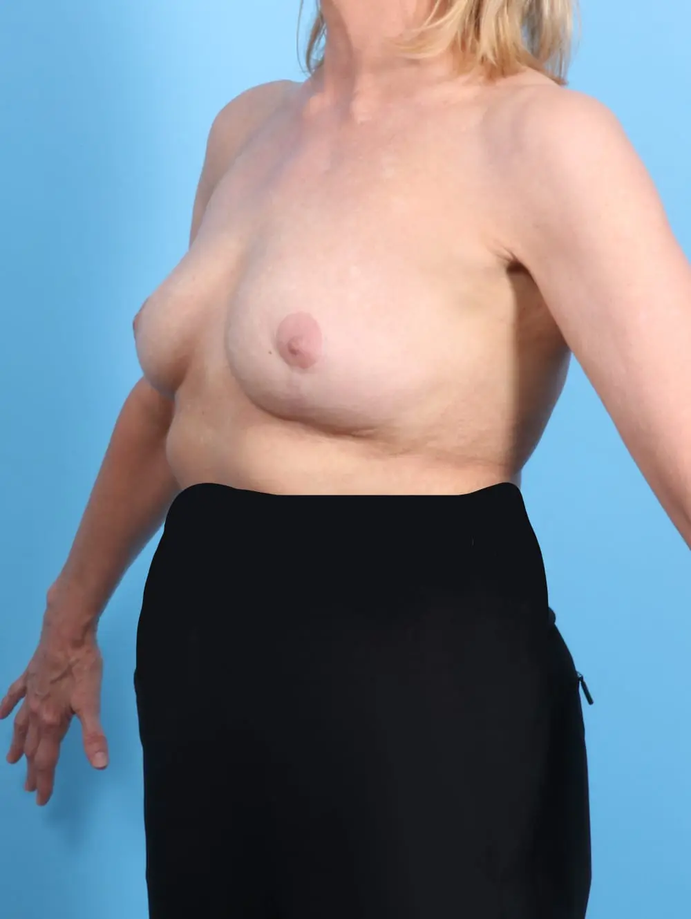 Breast Implant Removal Patient Photo - Case 21085 - after view-1
