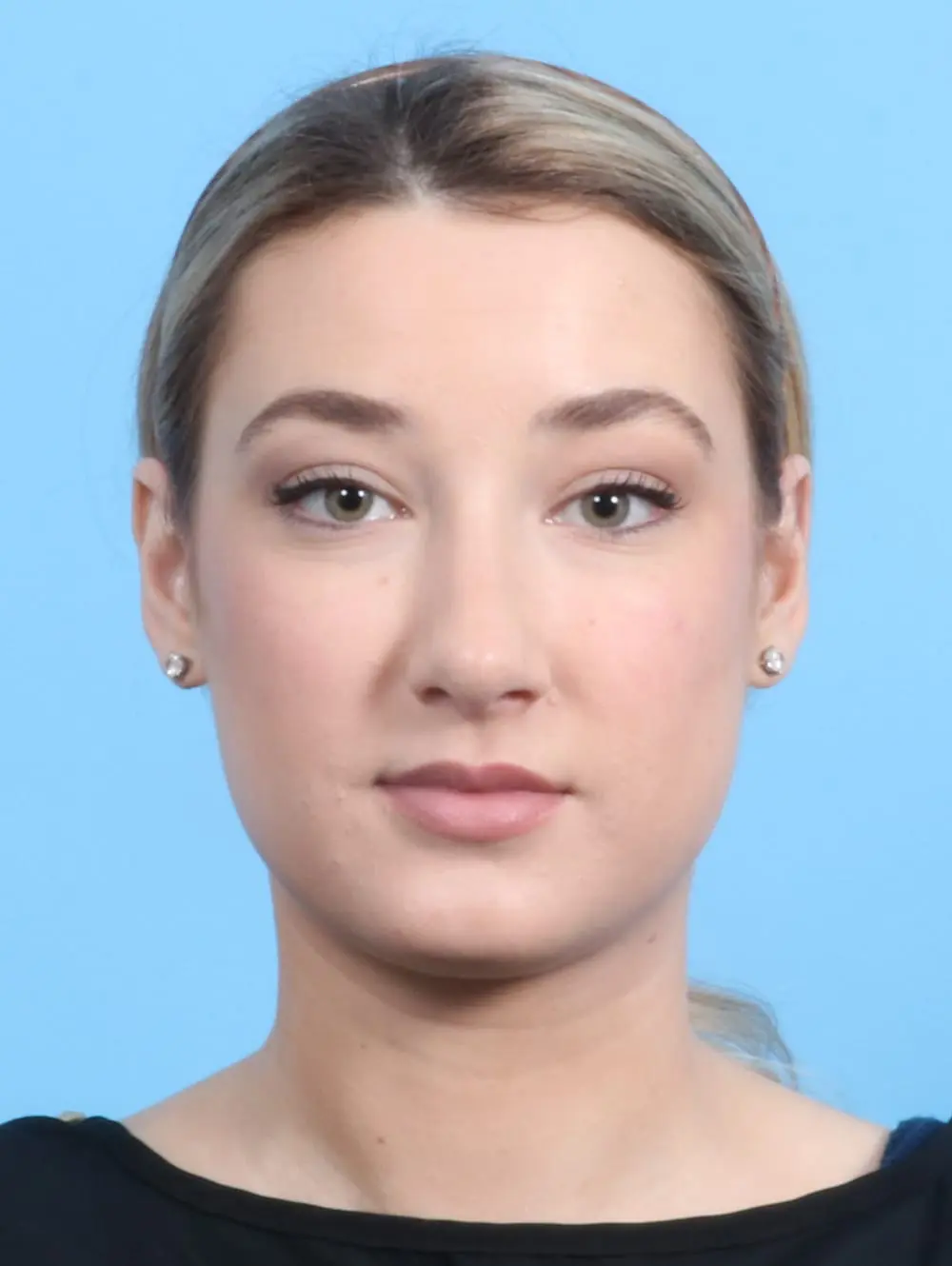 Rhinoplasty Patient Photo - Case 21101 - after view-1