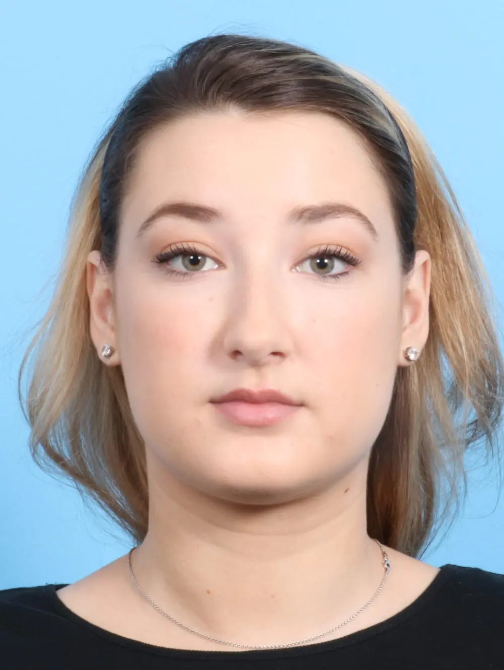 Rhinoplasty Patient Photo - Case 21101 - before view-1