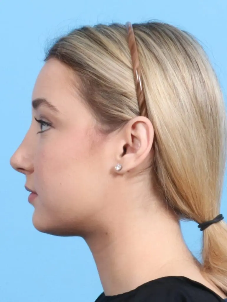 Rhinoplasty - Case 21101 - After