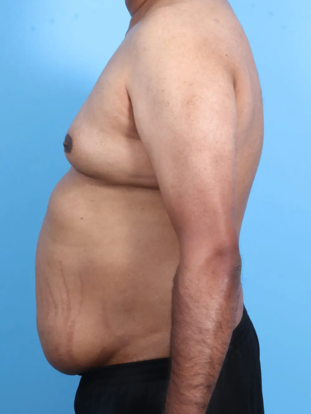 Male Tummy Tuck Patient Photo - Case 21176 - before view-2