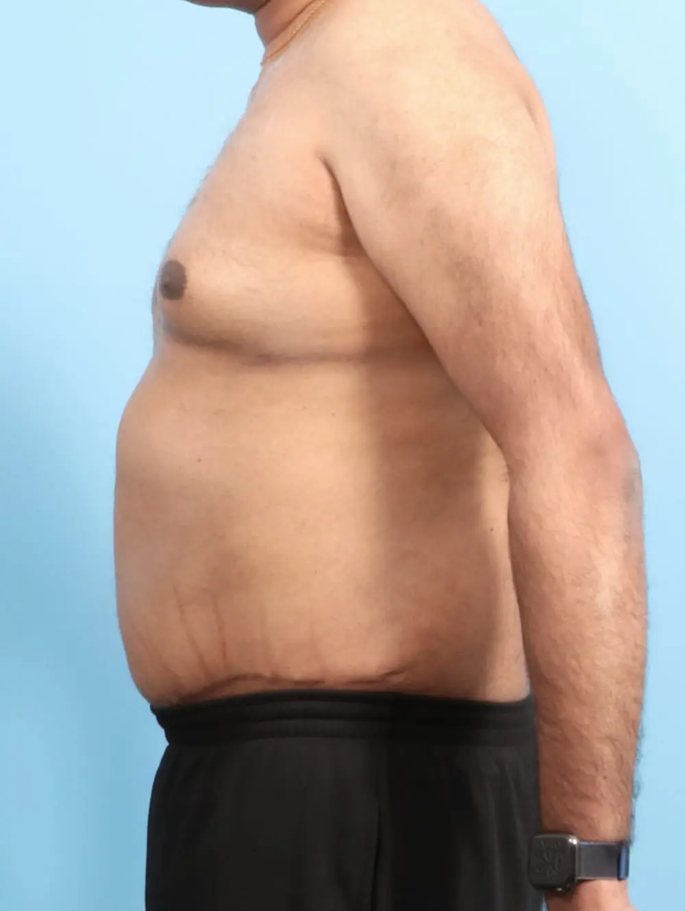 Male Tummy Tuck Patient Photo - Case 21176 - after view-2