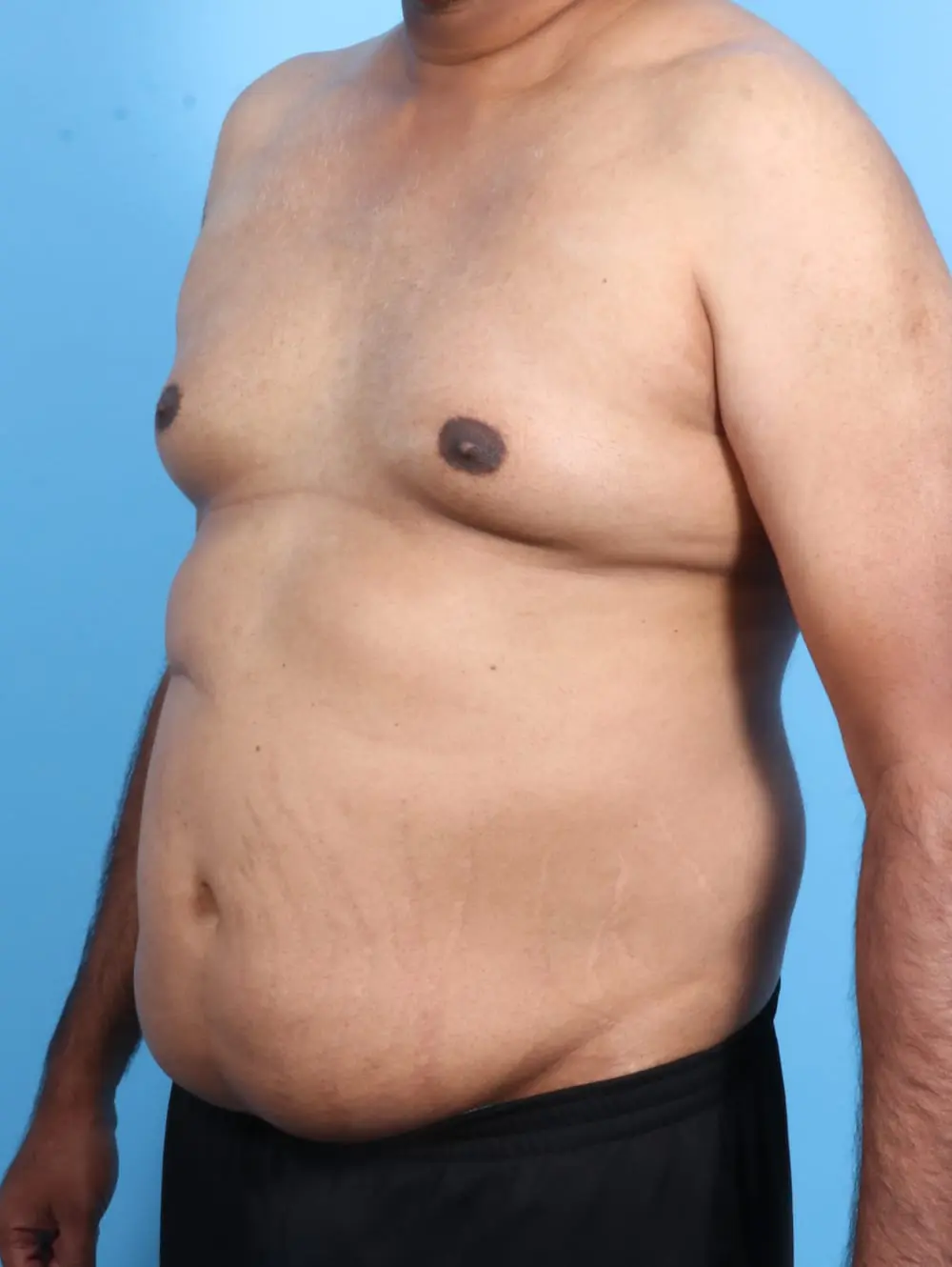 Male Tummy Tuck Patient Photo - Case 21176 - before view-1