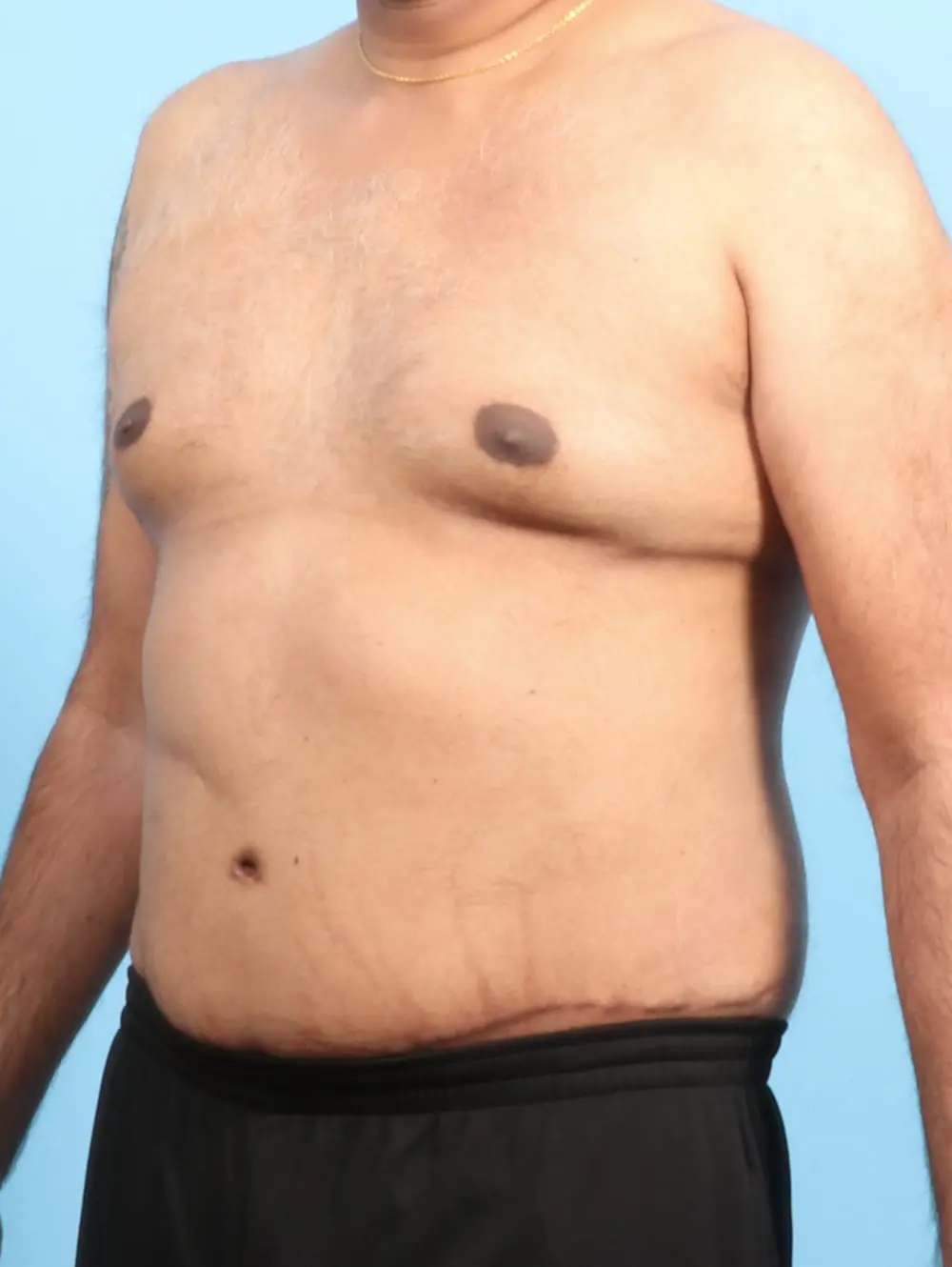 Male Tummy Tuck Patient Photo - Case 21176 - after view-1
