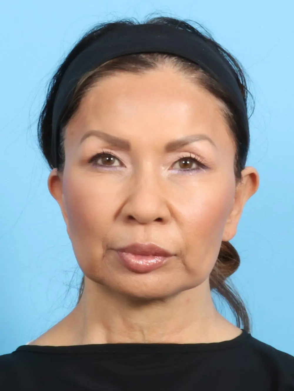 Chin Implant Patient Photo - Case 21258 - before view-2
