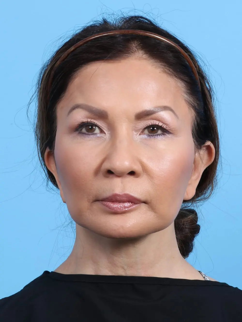 Chin Implant Patient Photo - Case 21258 - after view-2