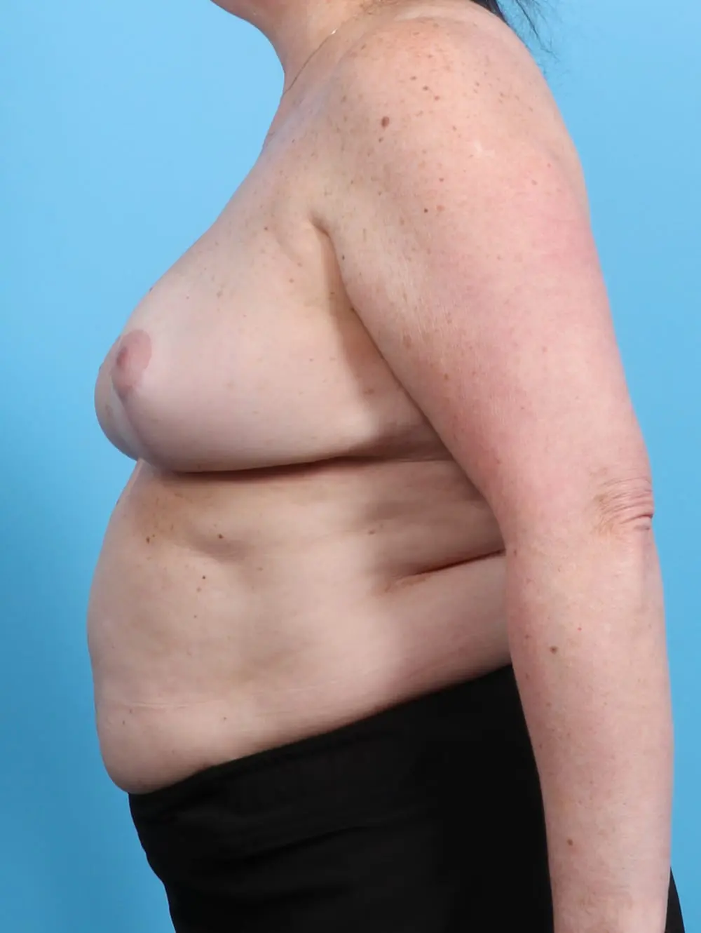 Breast Implant Removal Patient Photo - Case 21202 - after view-2