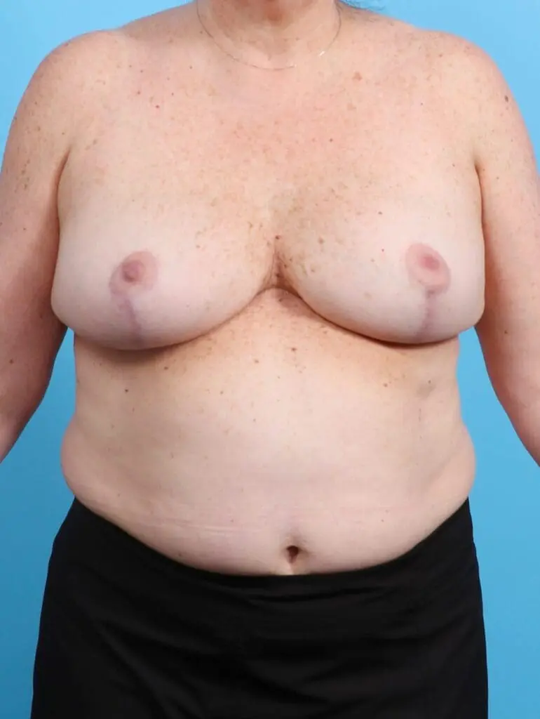 Breast Implant Removal - Case 21202 - After