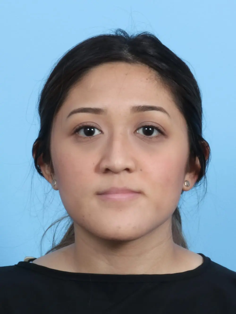 Rhinoplasty Patient Photo - Case 21219 - before view-1