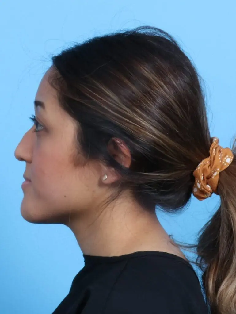 Rhinoplasty - Case 21219 - Before