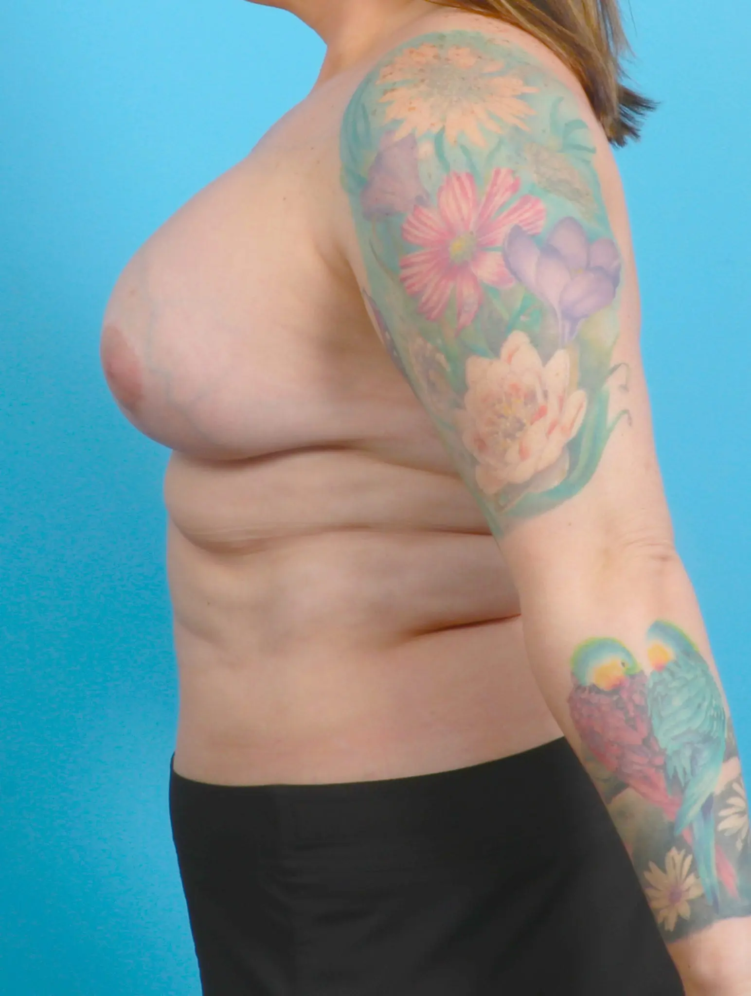 Breast Lift/Reduction with Implants Patient Photo - Case 21235 - after view-2
