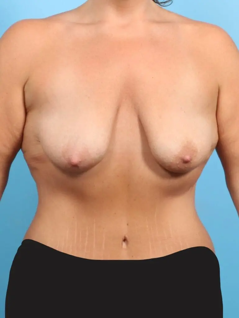 Breast Lift/Reduction with Implants - Case 21244 - Before