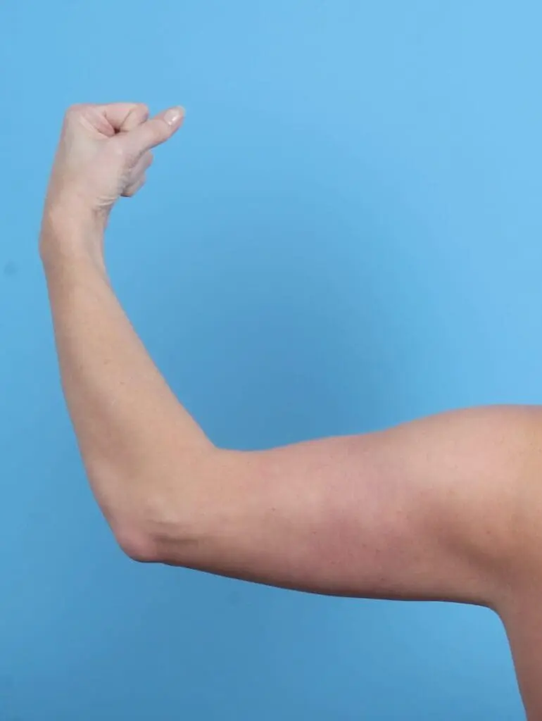 Arm Lift - Case 21254 - After