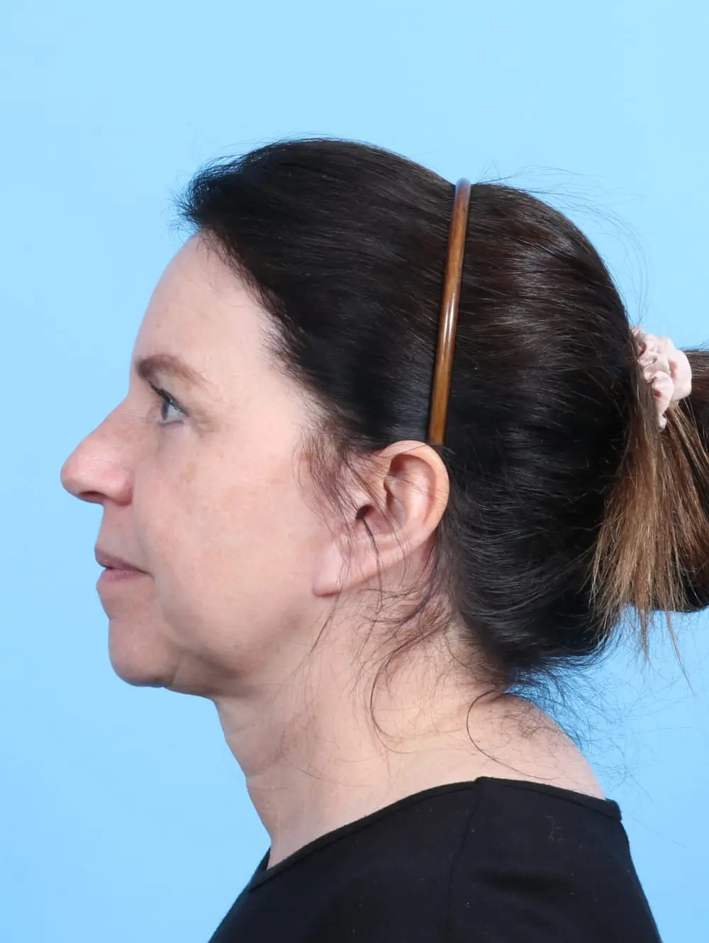 Brow Lift Patient Photo - Case 21261 - after view-2