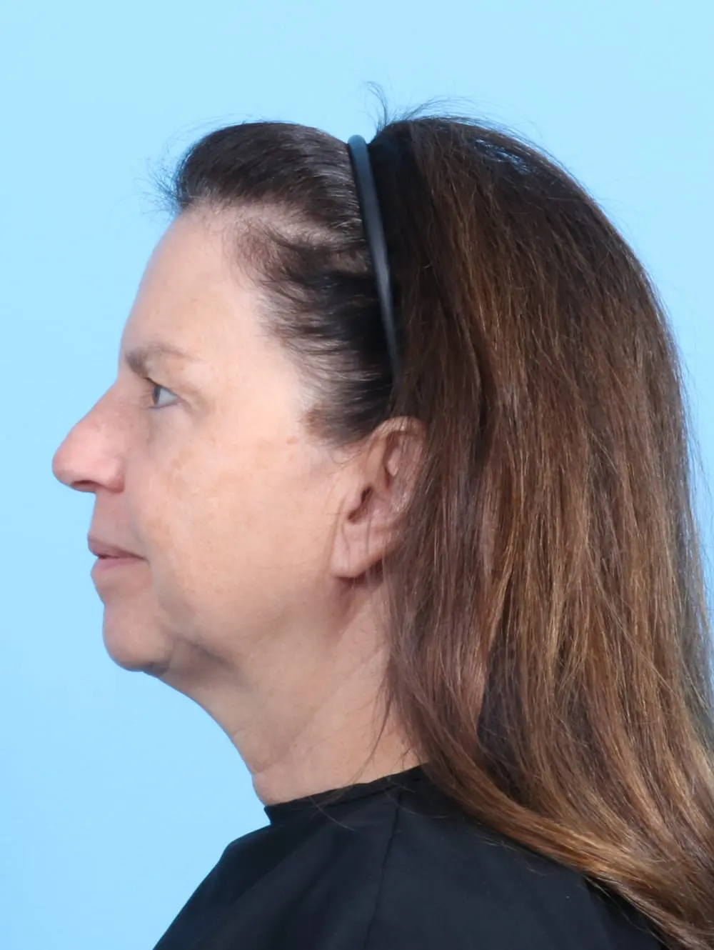 Brow Lift Patient Photo - Case 21261 - before view-2