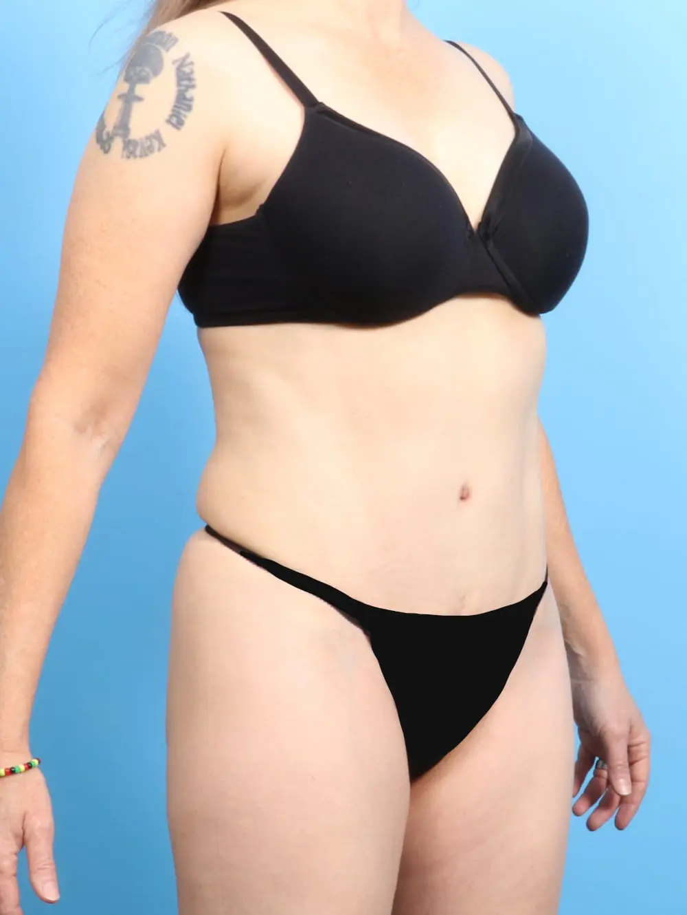 Tummy Tuck Patient Photo - Case 21271 - after view-1