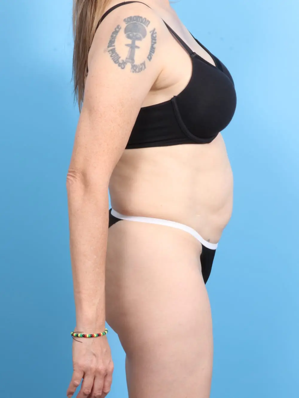 Tummy Tuck Patient Photo - Case 21271 - before view-2