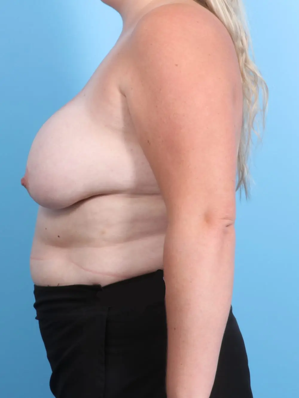 Breast Implant Removal Patient Photo - Case 21298 - before view-2