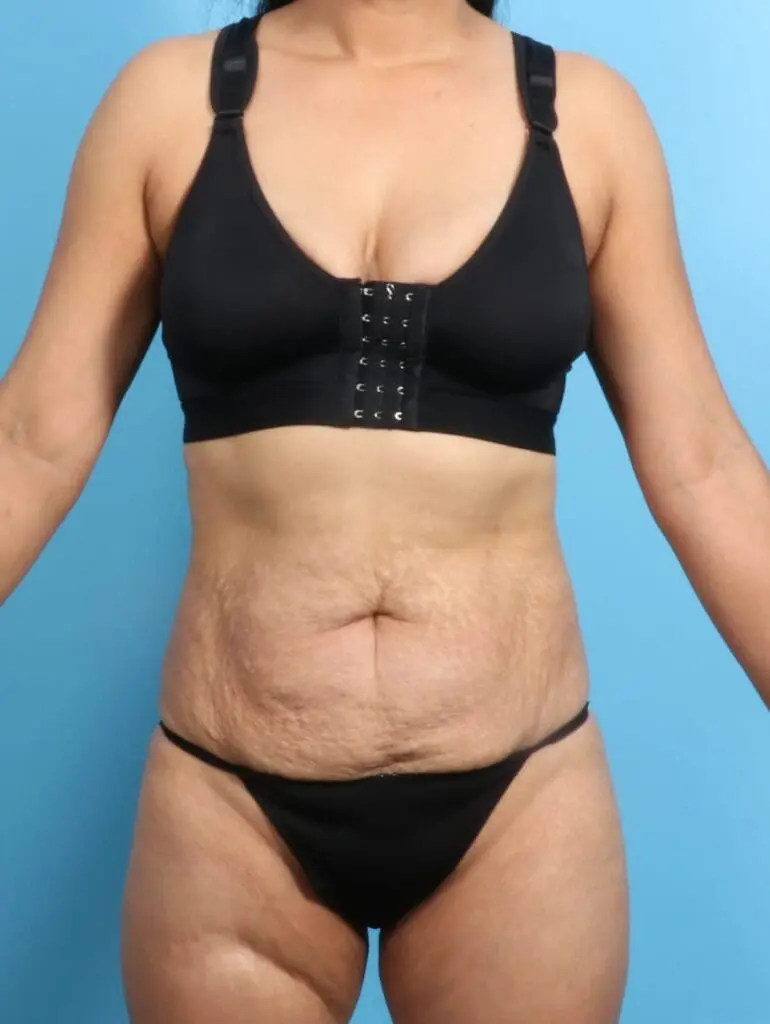 Tummy Tuck - Case 21306 - Before