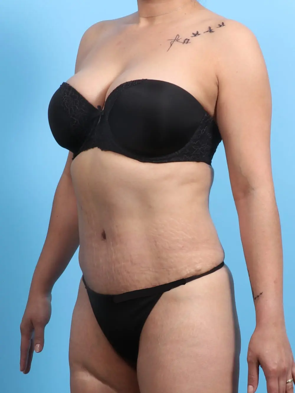 Tummy Tuck Patient Photo - Case 21306 - after view-1