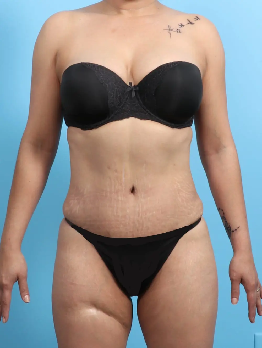 Tummy Tuck Patient Photo - Case 21306 - after view