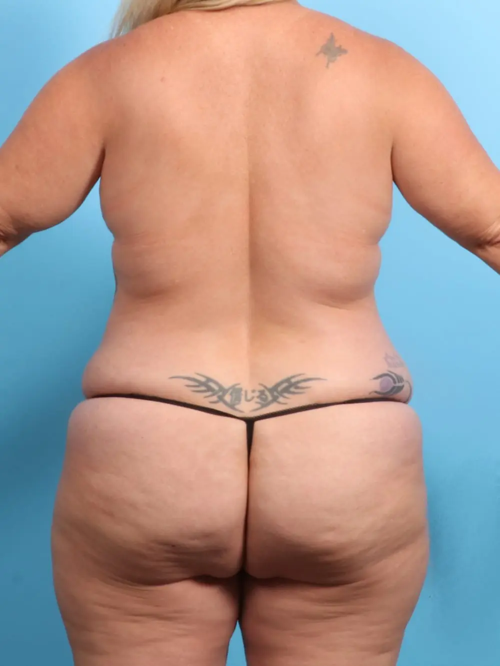 After Weight Loss Patient Photo - Case 21399 - before view-3