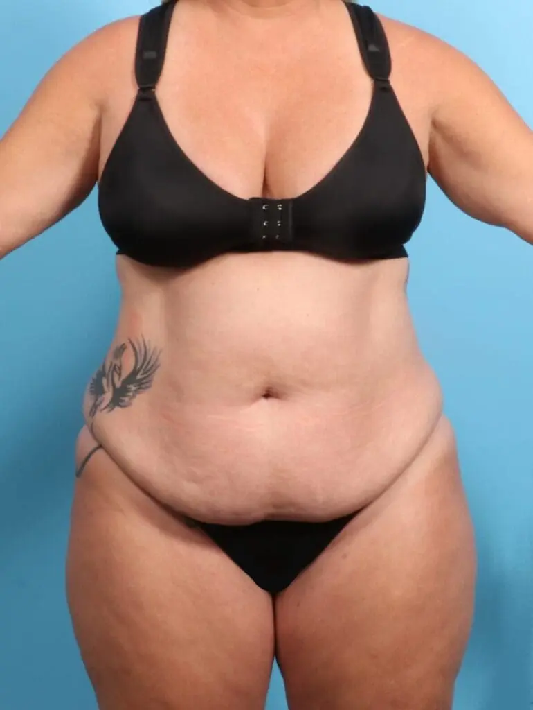 After Weight Loss - Case 21399 - Before