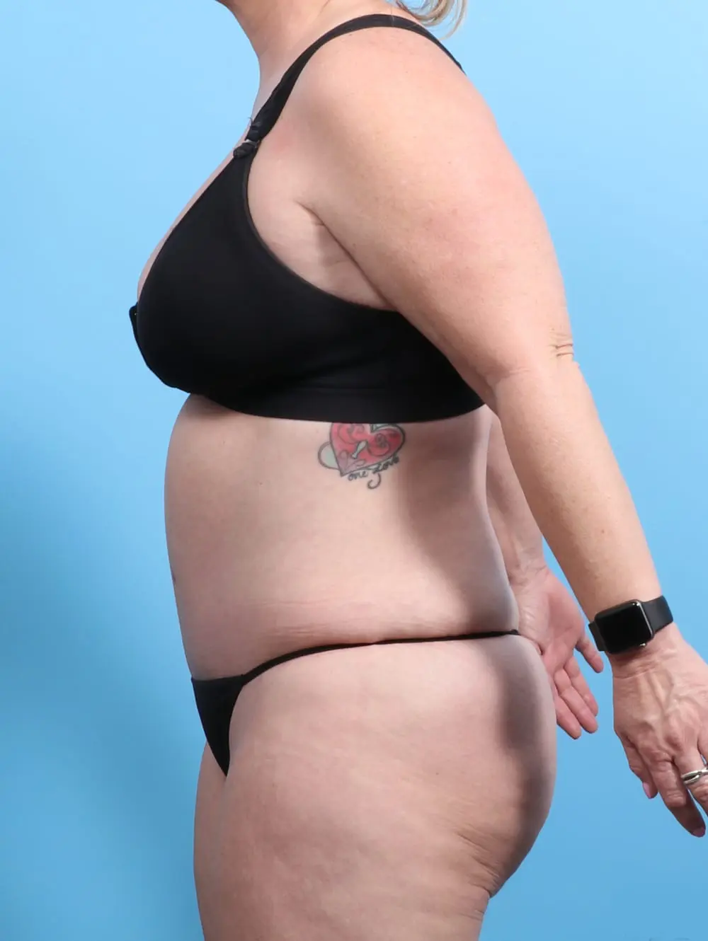 After Weight Loss Patient Photo - Case 21399 - after view-2