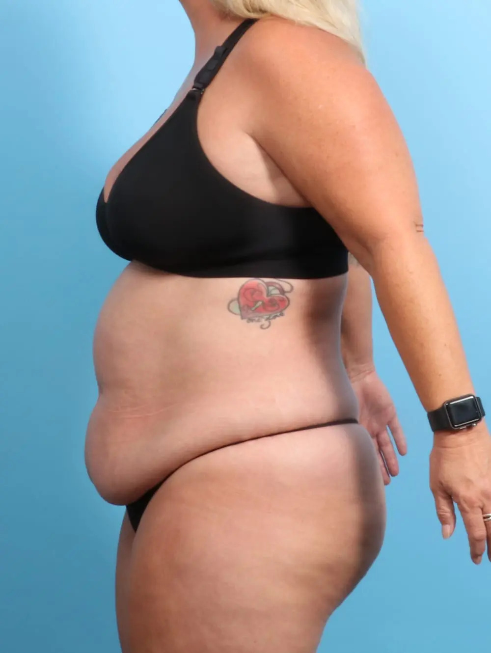 After Weight Loss Patient Photo - Case 21399 - before view-2