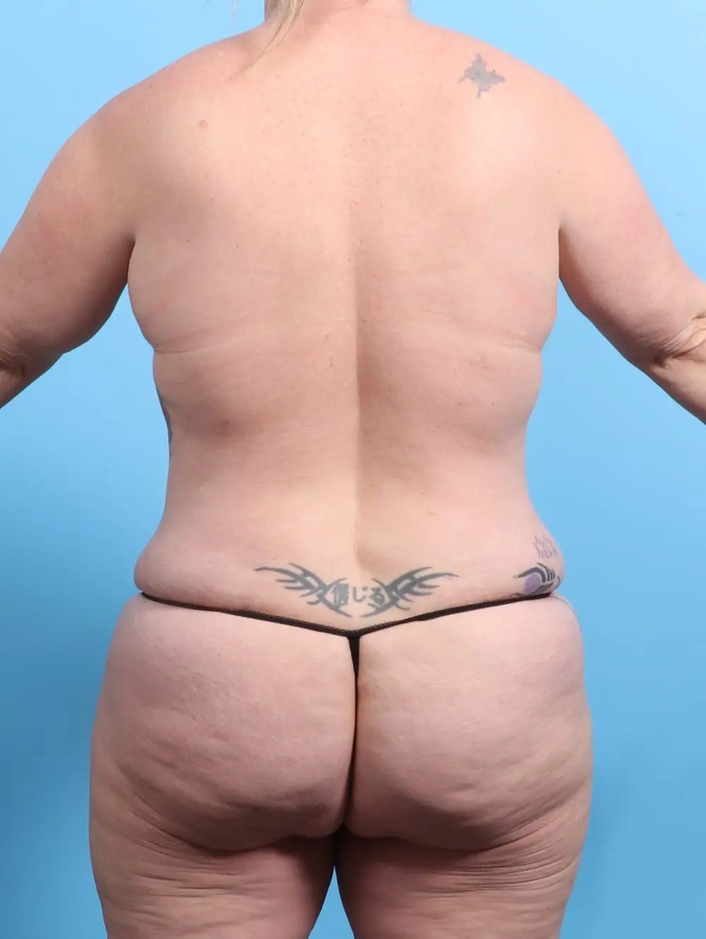 After Weight Loss Patient Photo - Case 21399 - after view-3